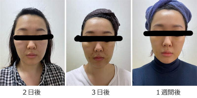 施術後イメージ