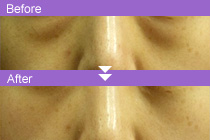 下まぶたたるみ取り施術前と後